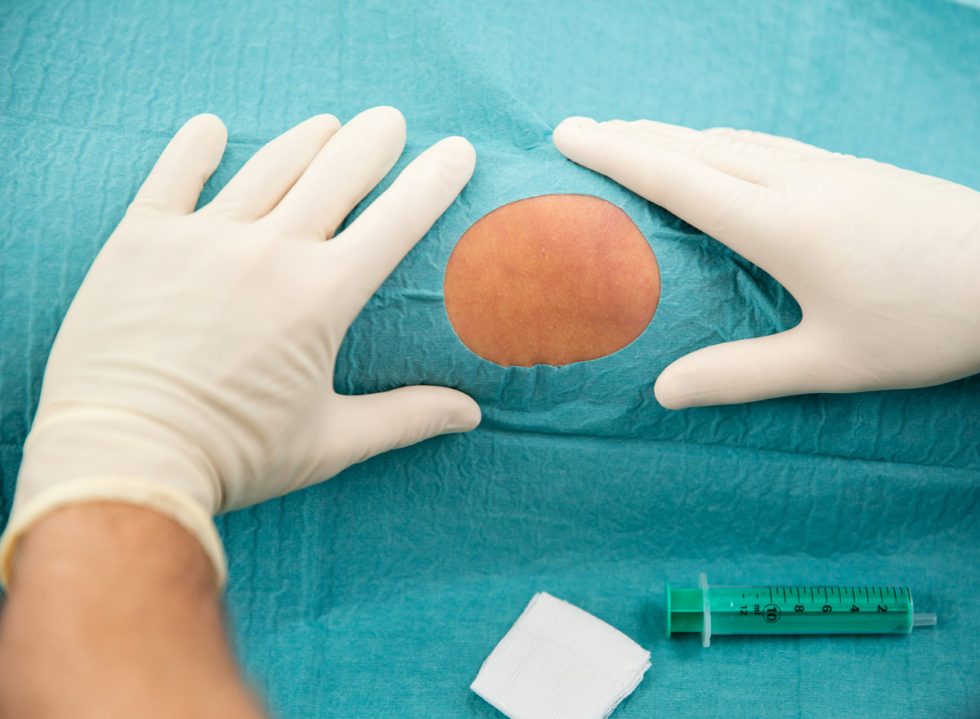 knorpelschaeden Kniechirurgie